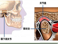 颞下颌关节紊乱病
