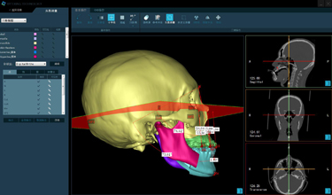 颅颌面外科手术规划系统软件